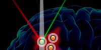 Researchers have created gold-core particles that gather around brain tumors (shown in red) an emit three different types of signals, which may lead to more precise, molecular-level imaging in the future. (Courtesy of Sam Gambhir)